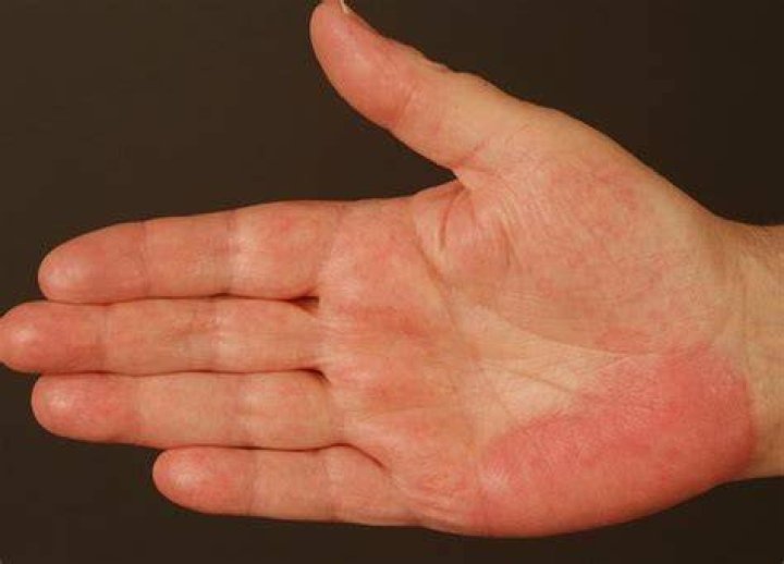 How do you get palmar erythema?